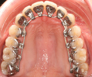 traitement orthodontie lingual garches vaucresson suresnes