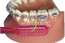 L’hygiène bucco-dentaire en Orthodontie
